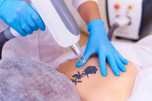 Tattoo Removal