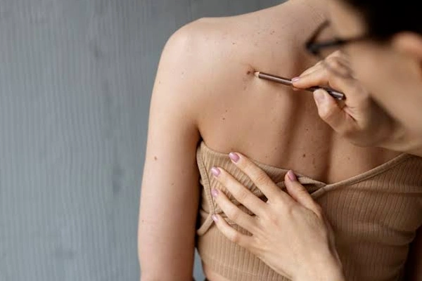 Mole, Warts and Skin Tags Removal