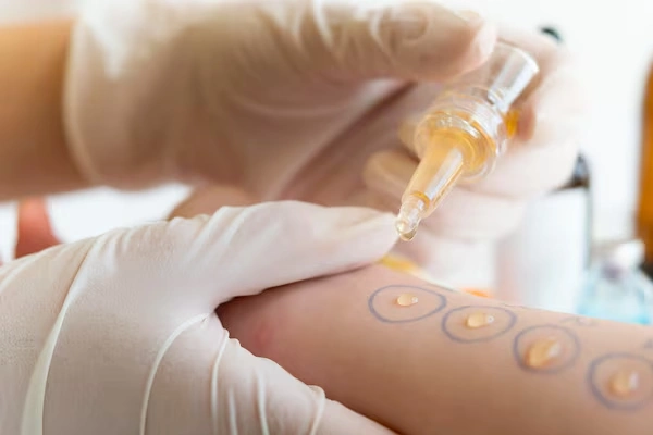 Skin Allergy Treatment
