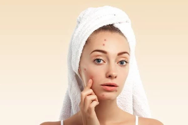 Acne Scar Treatment