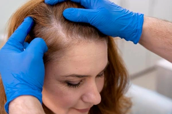 Hair Fall Treatment
