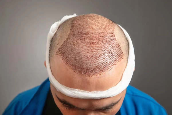 Hair Transplant