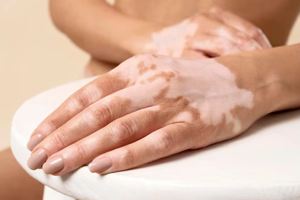 Vitiligo